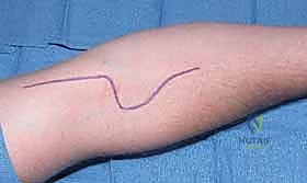 Illustration of decompression of pronator - Dr. Mohammed Hutaif