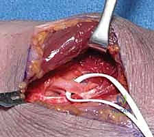 Illustration of decompression of pronator - Dr. Mohammed Hutaif