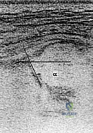 تأثير وضعية الجنين والتمهيد الخاطئ على مفصل الورك