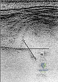 العوائق التشريحية التي تمنع رد مفصل الورك