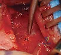 التشخيص الإشعاعي لخلع الورك التطوري
