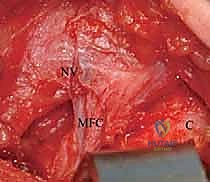 استئصال الرباط المدور المتضخم