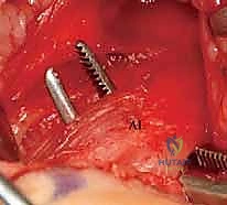 الوصول إلى العضلات وتحريرها