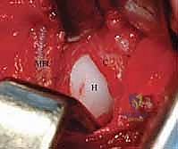 العلاج التحفظي باستخدام حزام بافليك
