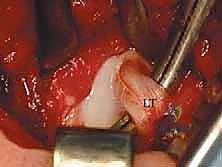 صورة توضيحية لـ جراحة الرد المفتوح الإنسي لخلع الورك التطوري: دليل شامل للمرضى مع الأستاذ الدكتور محمد هطيف