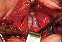 الشق الجراحي في المدخل الإنسي للورك