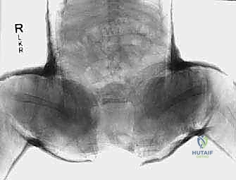 صورة توضيحية لـ جراحة الرد المفتوح الإنسي لخلع الورك التطوري: دليل شامل للمرضى مع الأستاذ الدكتور محمد هطيف