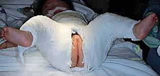 صورة توضيحية لـ جراحة الرد المفتوح الإنسي لخلع الورك التطوري: دليل شامل للمرضى مع الأستاذ الدكتور محمد هطيف