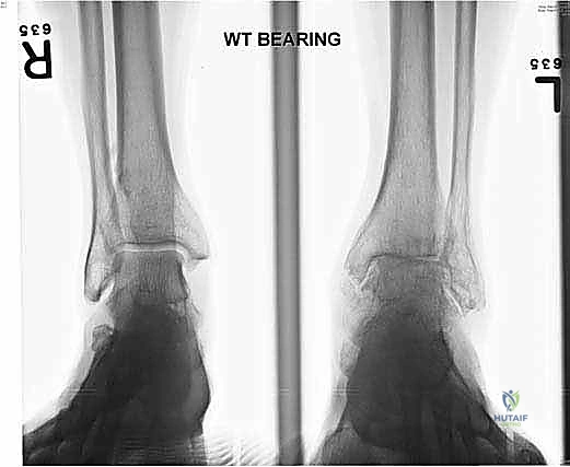 مراحل تآكل غضروف الكاحل