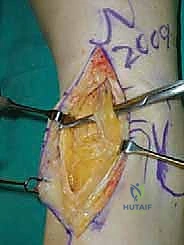 توضيح مسار الأعصاب والأوعية الدموية