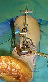 تثبيت الدليل بدبابيس معدنية