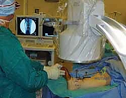 تنظيف المفصل بالكامل