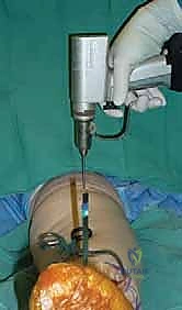 الشق الجراحي والنهج الأمامي