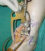 التحقق من المحاذاة بالأشعة