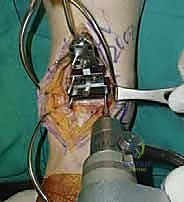 إزالة الشريحة العظمية التالفة