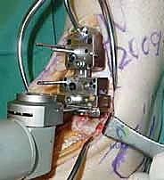 السطح الظنبوبي بعد القطع