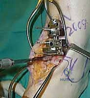 صورة توضيحية لـ استبدال مفصل الكاحل الكلي ستار STAR لعلاج خشونة الكاحل المتقدمة في صنعاء