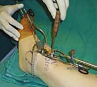 إجراء القطع العظمي الظنبوبي