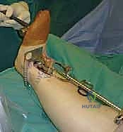 صورة طبية: استبدال مفصل الكاحل الكلي ستار STAR لعلاج خشونة الكاحل المتقدمة في صنعاء