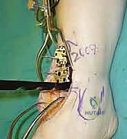 صورة توضيحية لـ استبدال مفصل الكاحل الكلي ستار STAR لعلاج خشونة الكاحل المتقدمة في صنعاء