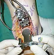 صورة توضيحية لـ استبدال مفصل الكاحل الكلي ستار STAR لعلاج خشونة الكاحل المتقدمة في صنعاء