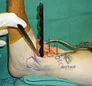 صورة طبية: استبدال مفصل الكاحل الكلي ستار STAR لعلاج خشونة الكاحل المتقدمة في صنعاء