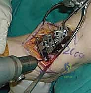 صورة طبية: استبدال مفصل الكاحل الكلي ستار STAR لعلاج خشونة الكاحل المتقدمة في صنعاء