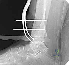 صورة طبية: استبدال مفصل الكاحل الكلي ستار STAR لعلاج خشونة الكاحل المتقدمة في صنعاء