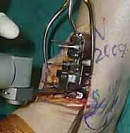 صورة طبية: استبدال مفصل الكاحل الكلي ستار STAR لعلاج خشونة الكاحل المتقدمة في صنعاء