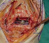 صورة طبية: استبدال مفصل الكاحل الكلي ستار STAR لعلاج خشونة الكاحل المتقدمة في صنعاء