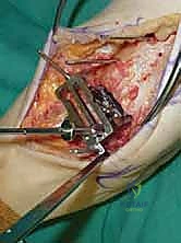 صورة طبية: استبدال مفصل الكاحل الكلي ستار STAR لعلاج خشونة الكاحل المتقدمة في صنعاء