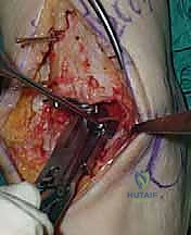 صورة طبية: استبدال مفصل الكاحل الكلي ستار STAR لعلاج خشونة الكاحل المتقدمة في صنعاء