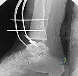 صورة طبية: استبدال مفصل الكاحل الكلي ستار STAR لعلاج خشونة الكاحل المتقدمة في صنعاء