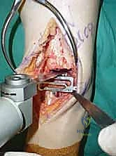 صورة طبية: استبدال مفصل الكاحل الكلي ستار STAR لعلاج خشونة الكاحل المتقدمة في صنعاء