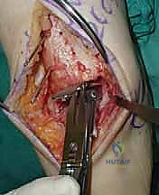 صورة طبية: استبدال مفصل الكاحل الكلي ستار STAR لعلاج خشونة الكاحل المتقدمة في صنعاء