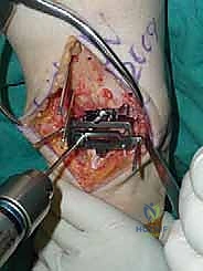 صورة طبية: استبدال مفصل الكاحل الكلي ستار STAR لعلاج خشونة الكاحل المتقدمة في صنعاء