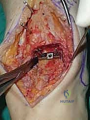 صورة طبية: استبدال مفصل الكاحل الكلي ستار STAR لعلاج خشونة الكاحل المتقدمة في صنعاء