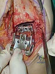 صورة طبية: استبدال مفصل الكاحل الكلي ستار STAR لعلاج خشونة الكاحل المتقدمة في صنعاء