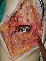 صورة طبية: استبدال مفصل الكاحل الكلي ستار STAR لعلاج خشونة الكاحل المتقدمة في صنعاء