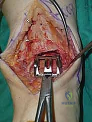 صورة طبية: استبدال مفصل الكاحل الكلي ستار STAR لعلاج خشونة الكاحل المتقدمة في صنعاء