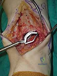 صورة طبية: استبدال مفصل الكاحل الكلي ستار STAR لعلاج خشونة الكاحل المتقدمة في صنعاء