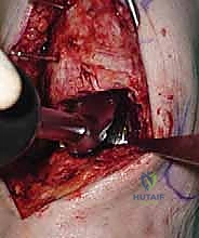 صورة طبية: استبدال مفصل الكاحل الكلي ستار STAR لعلاج خشونة الكاحل المتقدمة في صنعاء