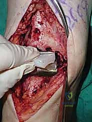 صورة طبية: استبدال مفصل الكاحل الكلي ستار STAR لعلاج خشونة الكاحل المتقدمة في صنعاء