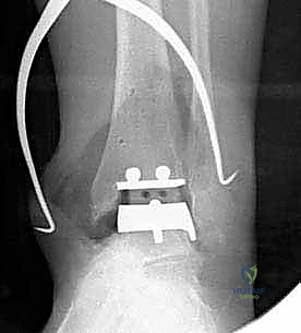 صورة طبية: استبدال مفصل الكاحل الكلي ستار STAR لعلاج خشونة الكاحل المتقدمة في صنعاء