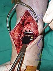 صورة طبية: استبدال مفصل الكاحل الكلي ستار STAR لعلاج خشونة الكاحل المتقدمة في صنعاء