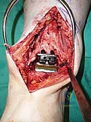 صورة طبية: استبدال مفصل الكاحل الكلي ستار STAR لعلاج خشونة الكاحل المتقدمة في صنعاء