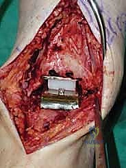 صورة طبية: استبدال مفصل الكاحل الكلي ستار STAR لعلاج خشونة الكاحل المتقدمة في صنعاء