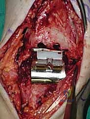 صورة طبية: استبدال مفصل الكاحل الكلي ستار STAR لعلاج خشونة الكاحل المتقدمة في صنعاء