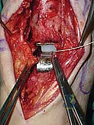 صورة طبية: استبدال مفصل الكاحل الكلي ستار STAR لعلاج خشونة الكاحل المتقدمة في صنعاء