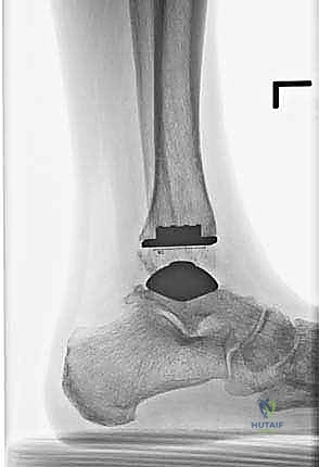 صورة طبية: استبدال مفصل الكاحل الكلي ستار STAR لعلاج خشونة الكاحل المتقدمة في صنعاء